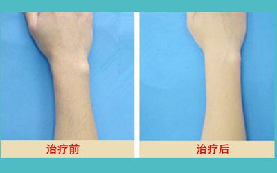 永久性脱毛价格表，科技新生活下的脱毛体验